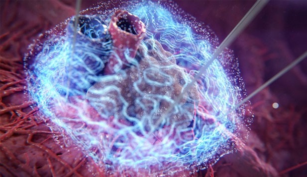 NanoKnife tumor environment technology image